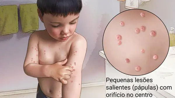MOLUSCO-CONTAGIOSO