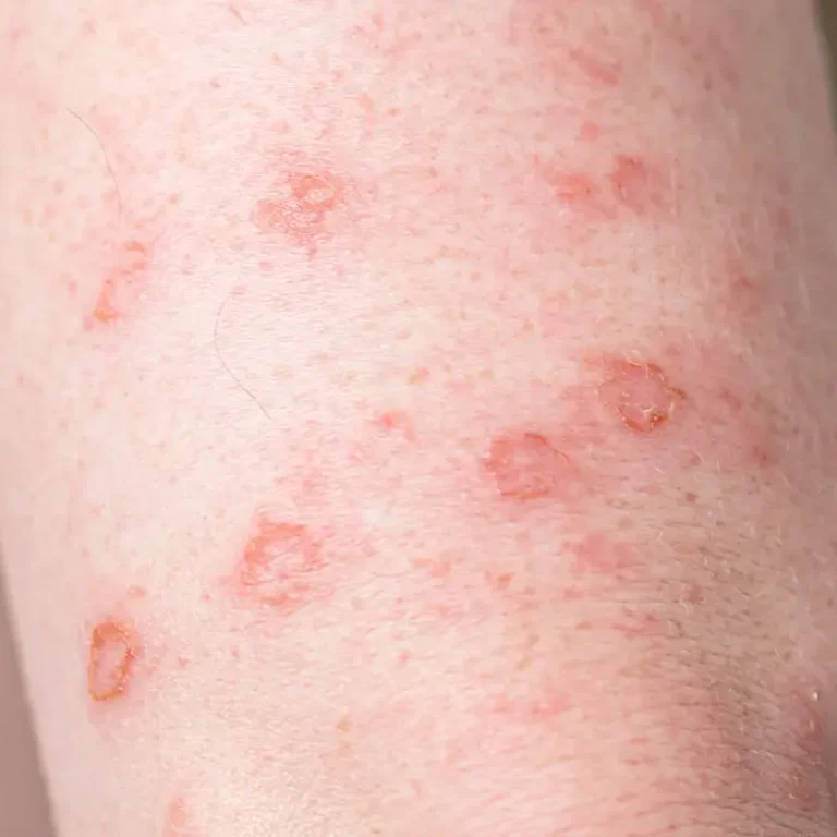 Sifilis-Tipos-tratamentos